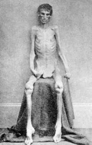 Disease and malnutrition killed many Civil War prisoners.